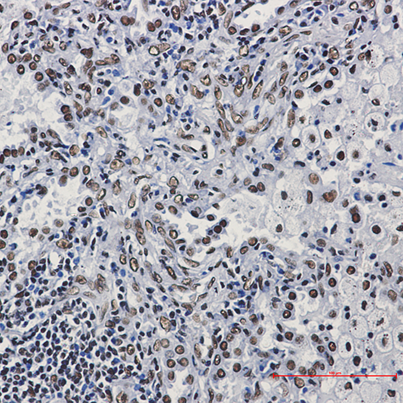 Immunohistochemistry of ILF3 in paraffin-embedded Human lung cancer tissue using ILF3 Rabbit mAb at dilution 1:50