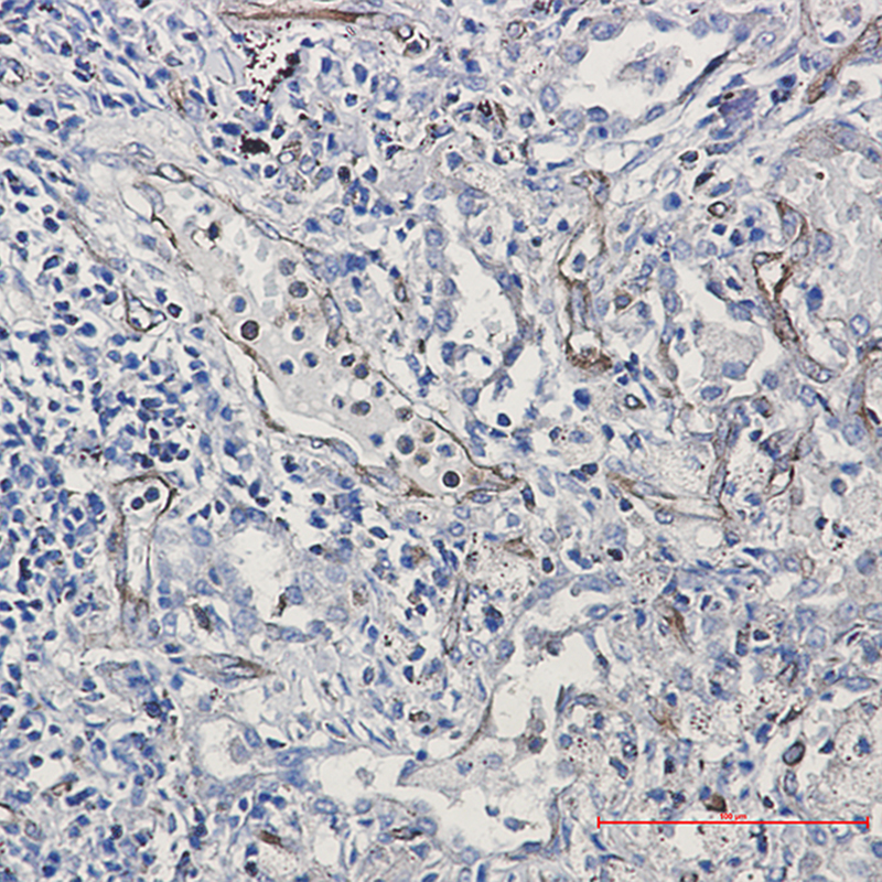 Immunohistochemistry of Moesin in paraffin-embedded Human lung cancer tissue using Moesin Rabbit mAb at dilution 1:50