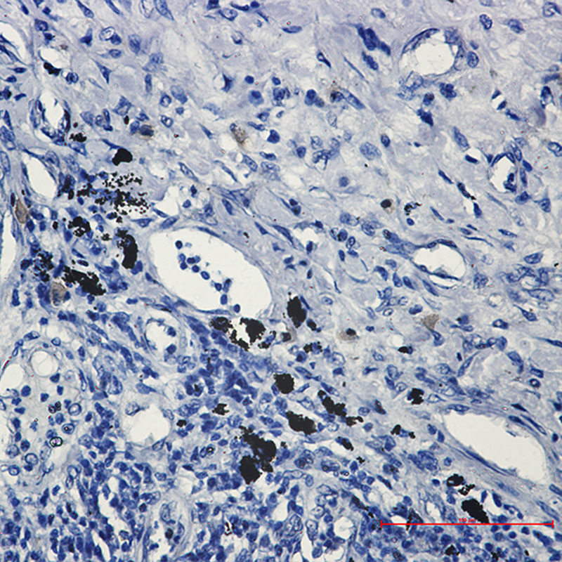 Immunohistochemistry of Smad2 in paraffin-embedded Human lung cancer tissue using Smad2 Rabbit mAb at dilution 1:50