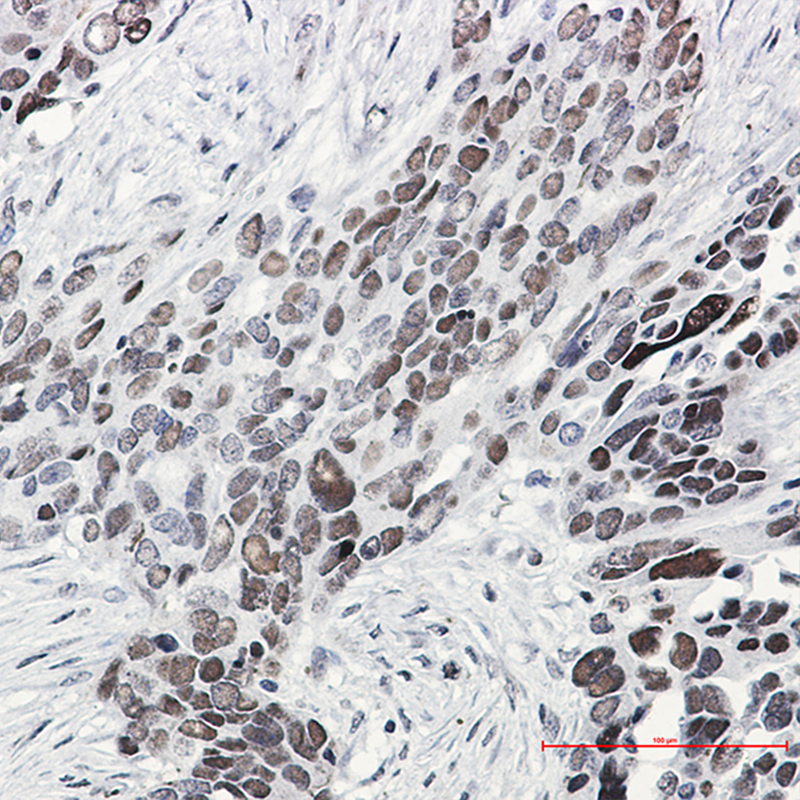 Immunohistochemistry of TCF-4 in paraffin-embedded Human Cholangiocarcinoma using TCF-4 Rabbit mAb at dilution 1:50