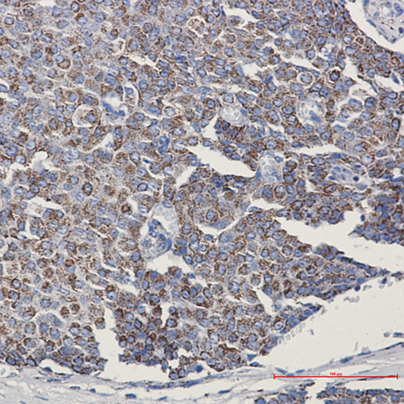 Immunohistochemistry of TOMM20 in paraffin-embedded Human breast cancer tissue using TOMM20 Rabbit mAb at dilution 1:50