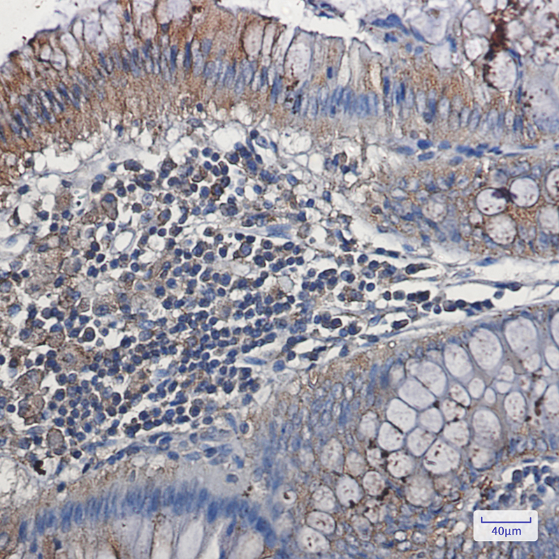 Immunohistochemistry of VEGF Receptor 1 in paraffin-embedded Human colon cancer tissue using VEGF Receptor 1 Rabbit mAb at dilution 1:50