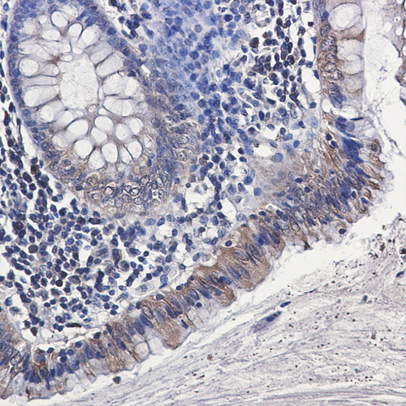 Immunohistochemistry of Osteopontin in paraffin-embedded Human colon cancer tissue using Osteopontin Rabbit mAb at dilution 1:50