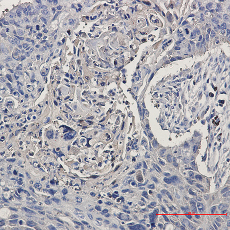 Immunohistochemistry of CCT2 in paraffin-embedded Human lung cancer tissue using CCT2 Rabbit mAb at dilution 1:50