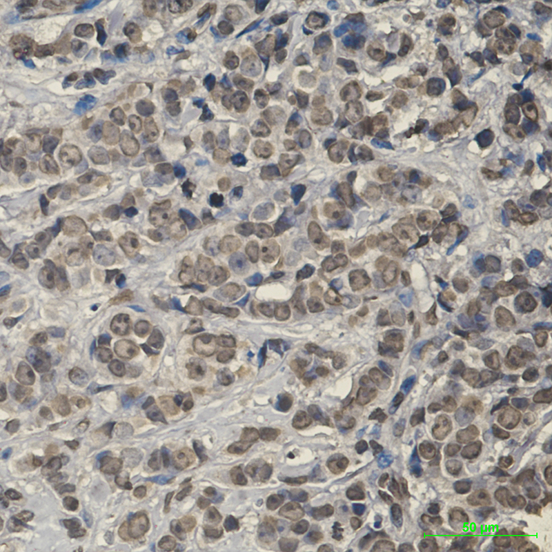 Immunohistochemical of Keap1 in Human breast cancer tissue using Keap1 antibody at dilution 1:20