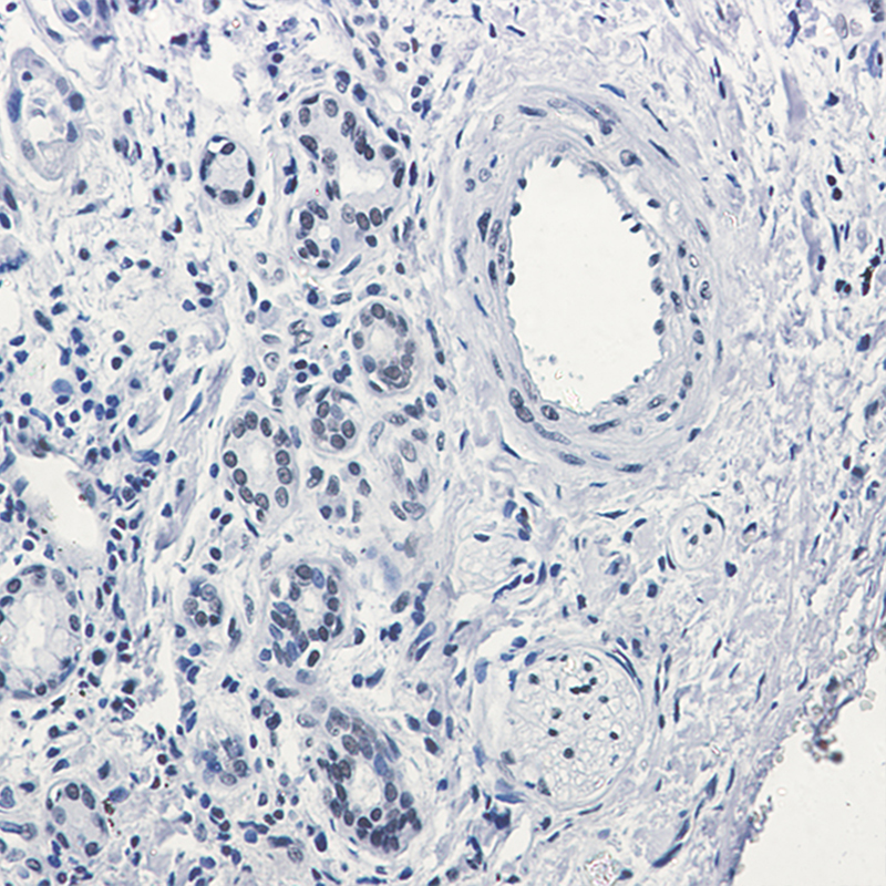 Immunohistochemistry of Rad21 in paraffin-embedded Human lung cancer tissue using Rad21 Rabbit mAb at dilution 1:50