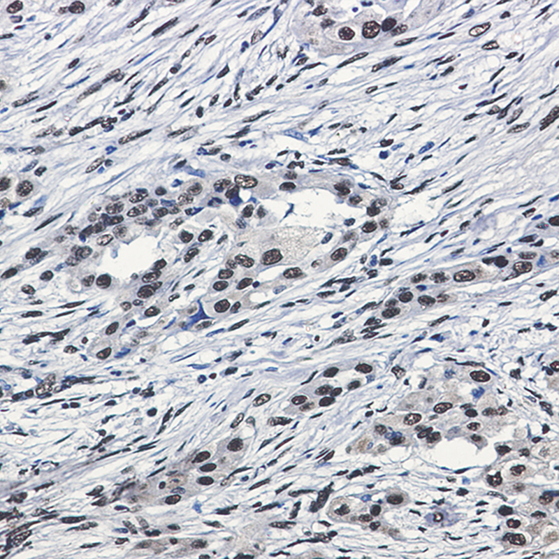 Immunohistochemistry of SF3B1 in paraffin-embedded Human lung cancer tissue using SF3B1 Rabbit mAb at dilution 1:50