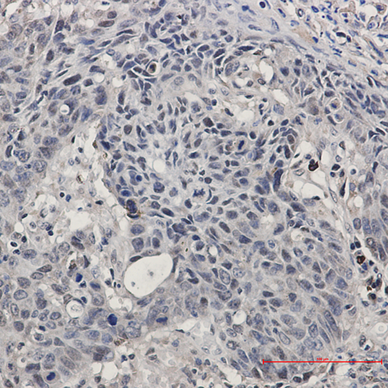 Immunohistochemistry of SMARCA2/BRM in paraffin-embedded Human lung cancer tissue using SMARCA2/BRM Rabbit mAb at dilution 1:50