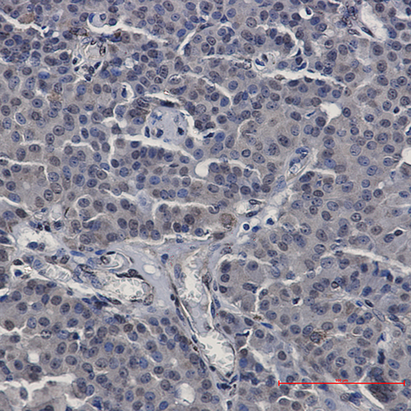 Immunohistochemistry of STAT5b in paraffin-embedded Human breast cancer tissue using STAT5b Rabbit mAb at dilution 1:50