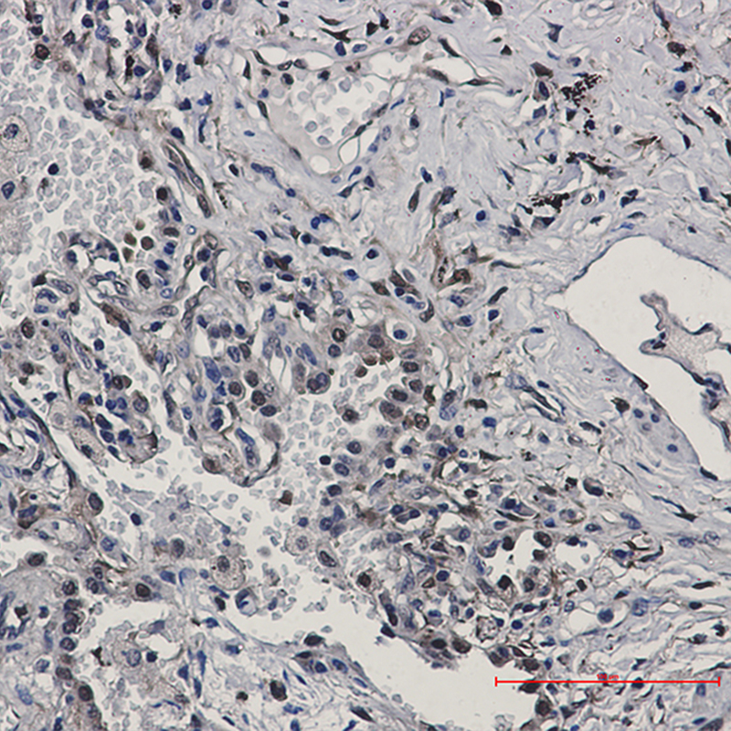 Immunohistochemistry of Visfatin in paraffin-embedded Human lung cancer tissue using Visfatin Rabbit mAb at dilution 1:50