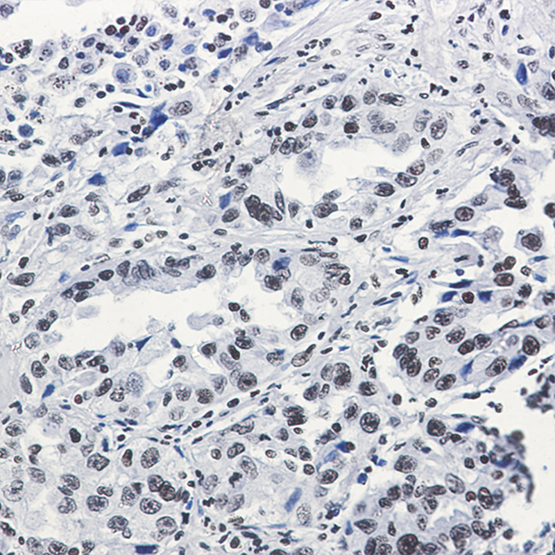 Immunohistochemistry of Histone H3 (acetyl-Lys27) in paraffin-embedded Human lung cancer tissue using Histone H3 (acetyl-Lys27) Rabbit mAb at dilution 1:50