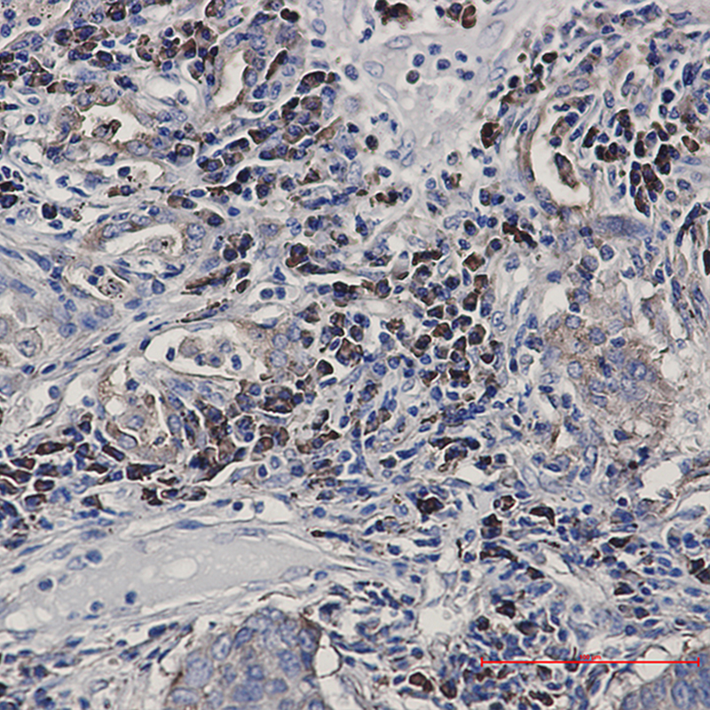 Immunohistochemistry of Alkaline Phosphatase, Tissue Non-Specific in paraffin-embedded Human lung cancer tissue using Alkaline Phosphatase, Tissue Non-Specific Rabbit mAb at dilution 1:50