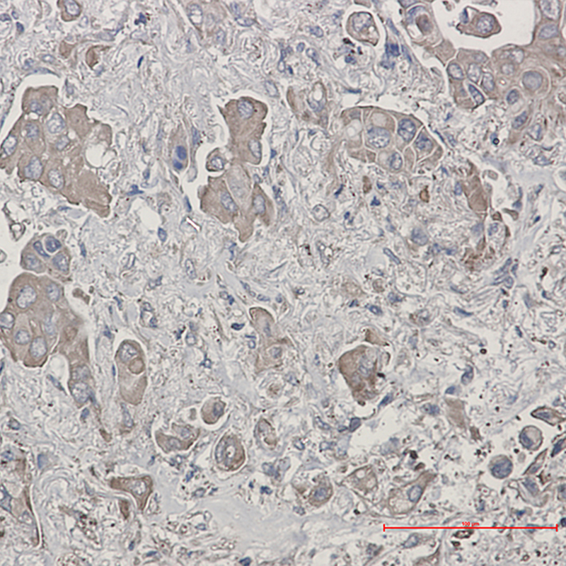 Immunohistochemistry of Bid in paraffin-embedded liver cancer tissue using Bid Rabbit mAb at dilution 1:50