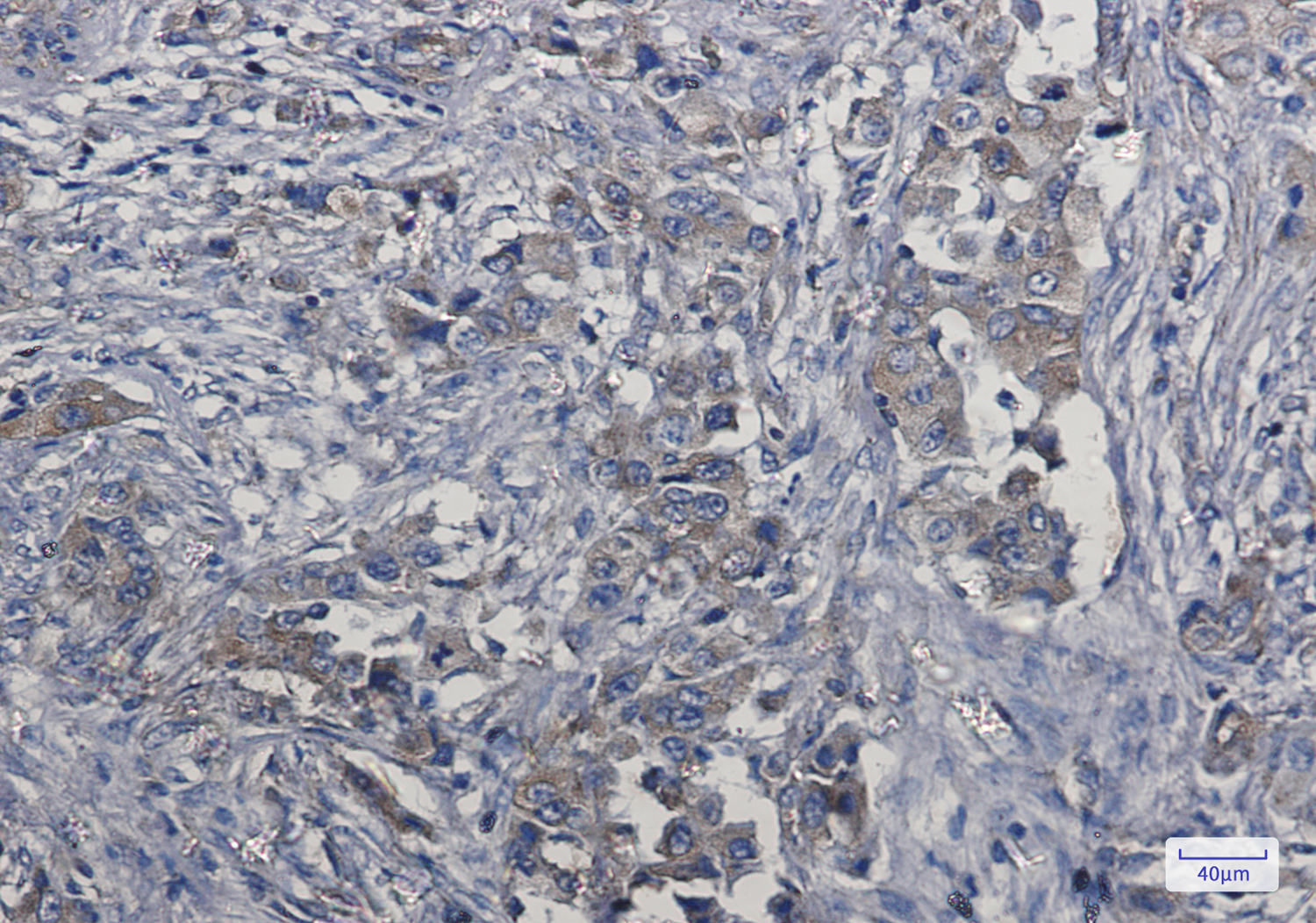 Immunohistochemistry of Met (c-Met) in paraffin-embedded Human lung cancer tissue using Met (c-Met) Rabbit mAb at dilution 1:50