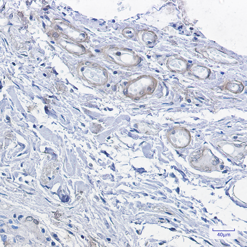 Immunohistochemistry of cAMP Protein Kinase Catalytic subunit  in paraffin-embedded Human colon cancer tissue using cAMP Protein Kinase Catalytic subunit  Rabbit mAb at dilution 1:100