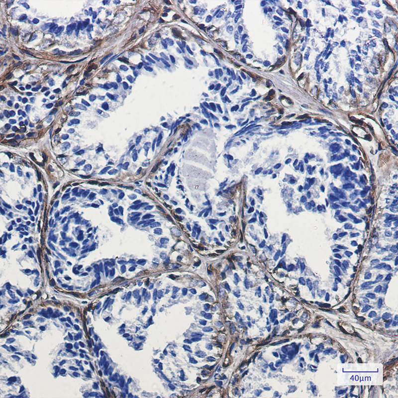 Immunohistochemistry of Caveolin-1 in paraffin-embedded Human breast cancer tissue using Caveolin-1 Rabbit mAb at dilution 1:100