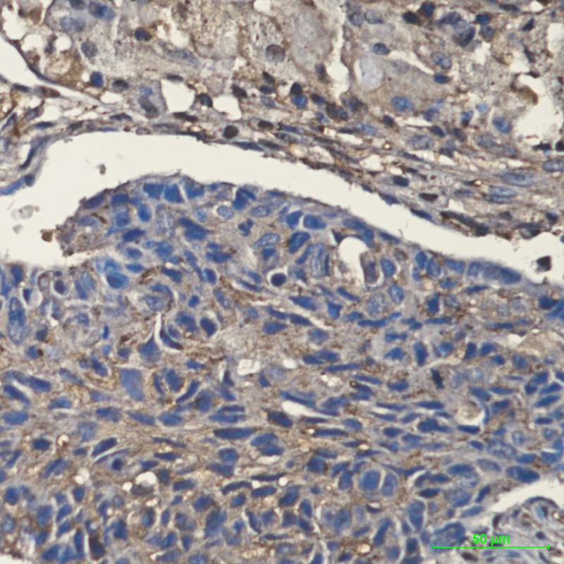 Immunohistochemical of Cofilin in Human lung cancer tissue using Cofilin antibody at dilution 1:200