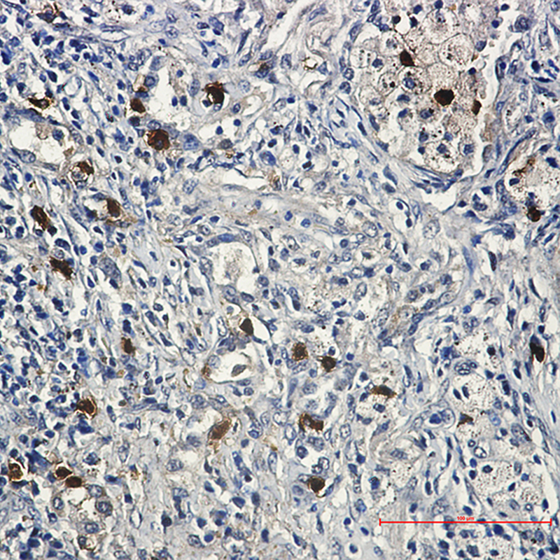 Immunohistochemistry of Cyclin E2 in paraffin-embedded Human lung cancer tissue using Cyclin E2 Rabbit mAb at dilution 1:50