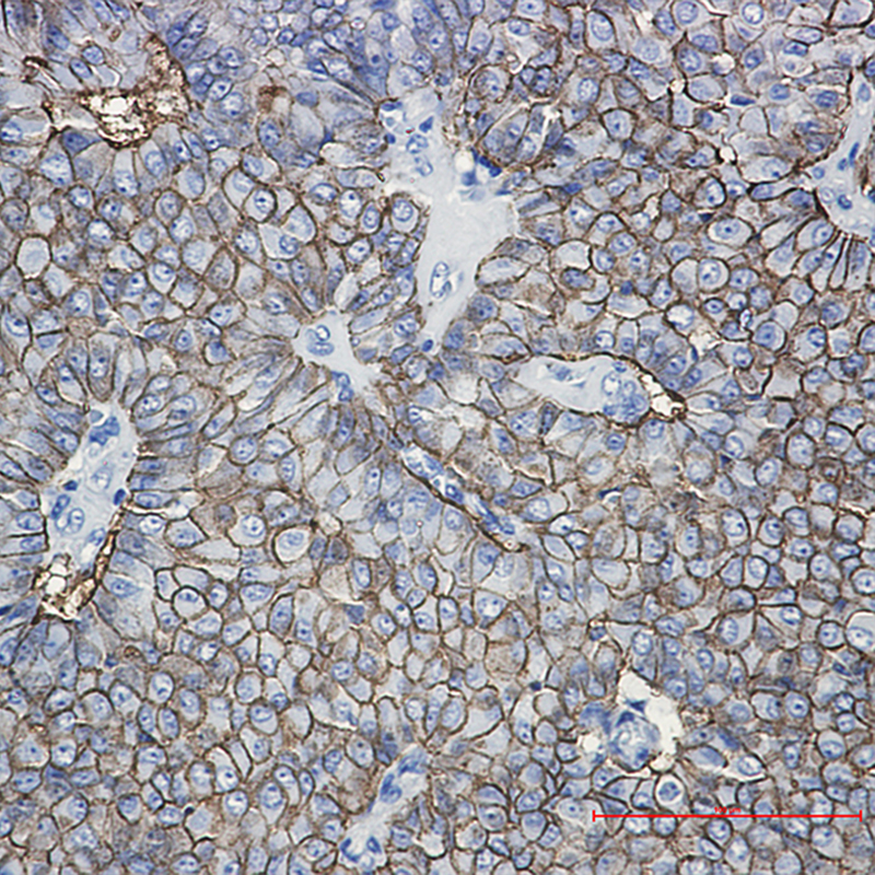 Immunohistochemistry of EpCAM in paraffin-embedded Human breast cancer tissue using EpCAM Rabbit mAb at dilution 1:50