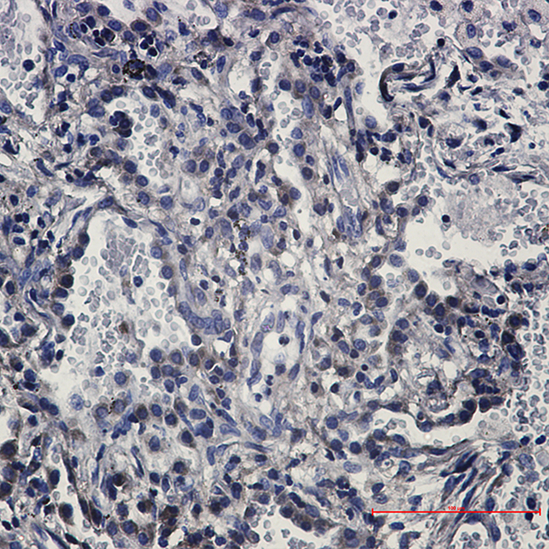 Immunohistochemistry of Fas in paraffin-embedded Human lung cancer tissue using Fas Rabbit mAb at dilution 1:50