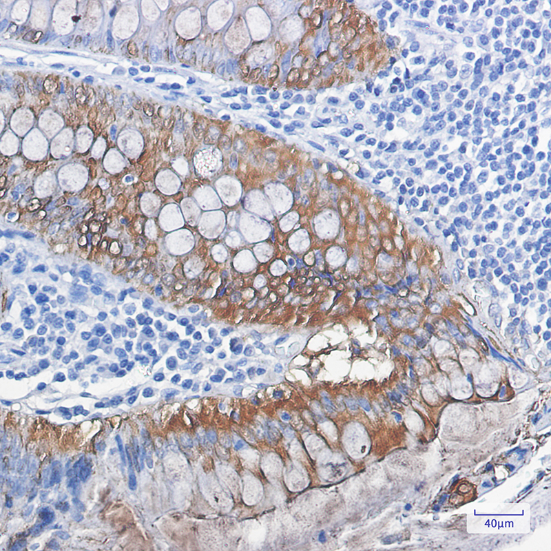 Immunohistochemistry of Galectin 3 in paraffin-embedded Human colon cancer tissue using Galectin 3 Rabbit mAb at dilution 1:100