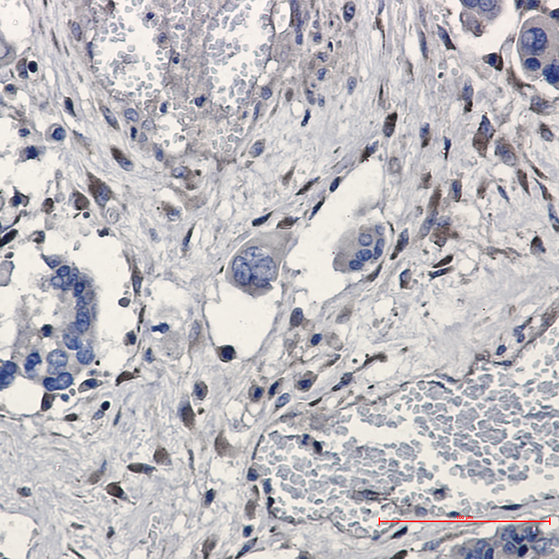 Immunohistochemistry of GNB2 in paraffin-embedded Human Cholangiocarcinoma using GNB2 Rabbit mAb at dilution 1:20