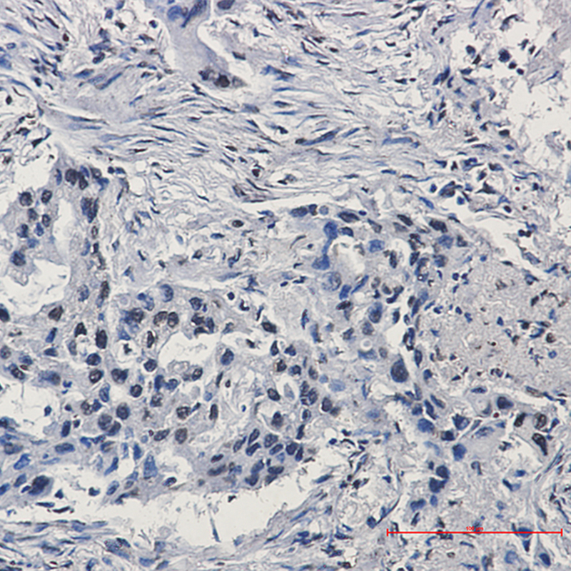 Immunohistochemistry of HIF1 beta in paraffin-embedded Human lung cancer tissue using HIF1 beta Rabbit mAb at dilution 1:50