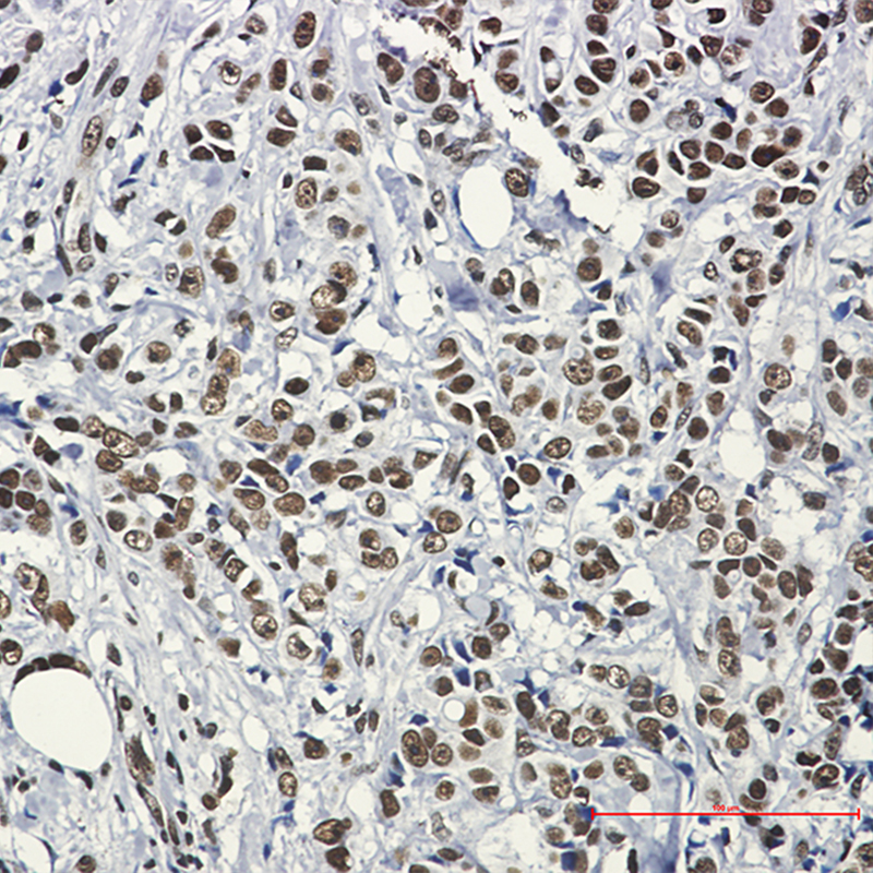 Immunohistochemistry of HSF1 in paraffin-embedded Human breast cancer tissue using HSF1 Rabbit mAb at dilution 1:50