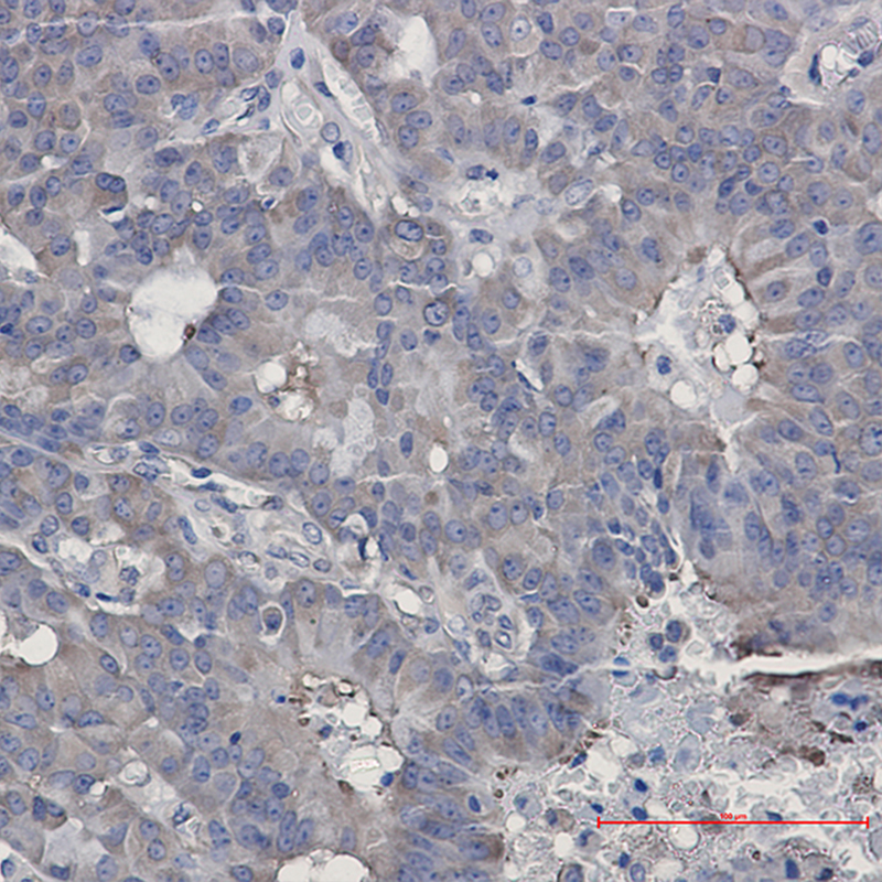 Immunohistochemistry of Hsp90 beta in paraffin-embedded Human breast cancer tissue using Hsp90 beta Rabbit mAb at dilution 1:50