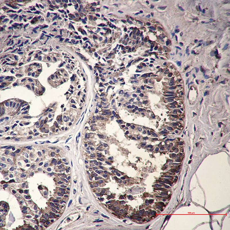 Immunohistochemistry of IMPDH2 in paraffin-embedded Human breast cancer tissue using IMPDH2 Rabbit mAb at dilution 1:50