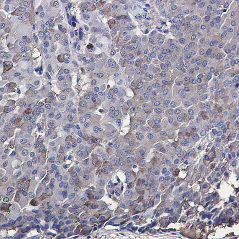 Immunohistochemistry of IRF7 in paraffin-embedded Human breast cancer tissue using IRF7 Rabbit mAb at dilution 1:50