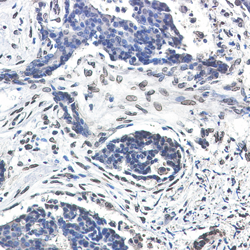 Immunohistochemistry of Lamin A/C in paraffin-embedded Human breast cancer tissue using Lamin A/C Rabbit mAb at dilution 1:50