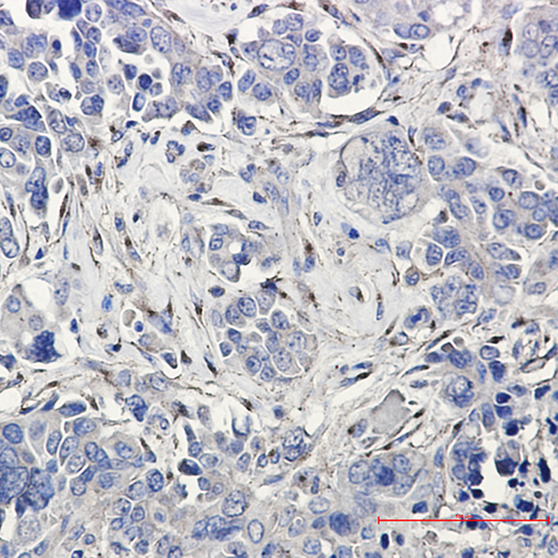 Immunohistochemistry of LRP1 in paraffin-embedded Human Cholangiocarcinoma using LRP1 Rabbit mAb at dilution 1:20