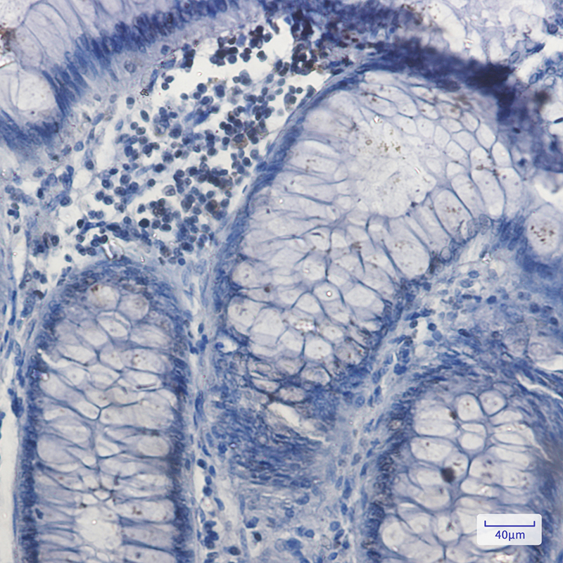 Immunohistochemistry of NRF1 in paraffin-embedded Human colon cancer tissue using NRF1 Rabbit mAb at dilution 1:50