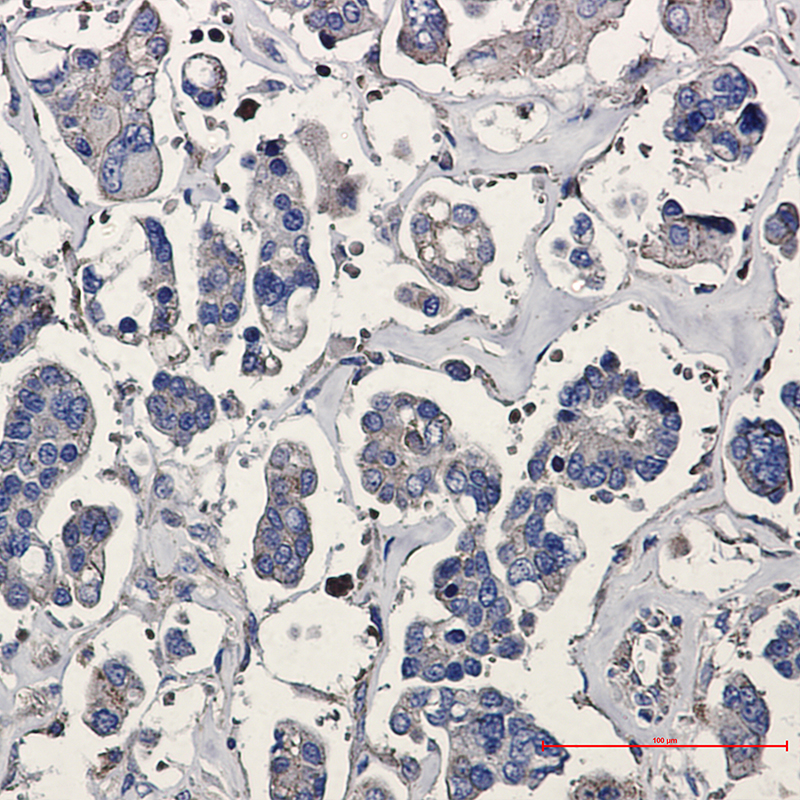 Immunohistochemistry of p16 ARC in paraffin-embedded Human Cholangiocarcinoma using p16 ARC Rabbit mAb at dilution 1/20