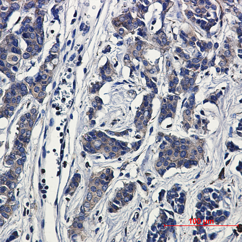 Immunohistochemical of Paxillin in Human breast cancer tissue using Paxillin antibody at dilution 1:20