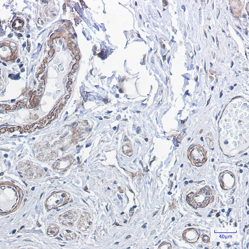 Immunohistochemistry of PPP1CB in paraffin-embedded Human colon cancer tissue using PPP1CB Rabbit mAb at dilution 1:100