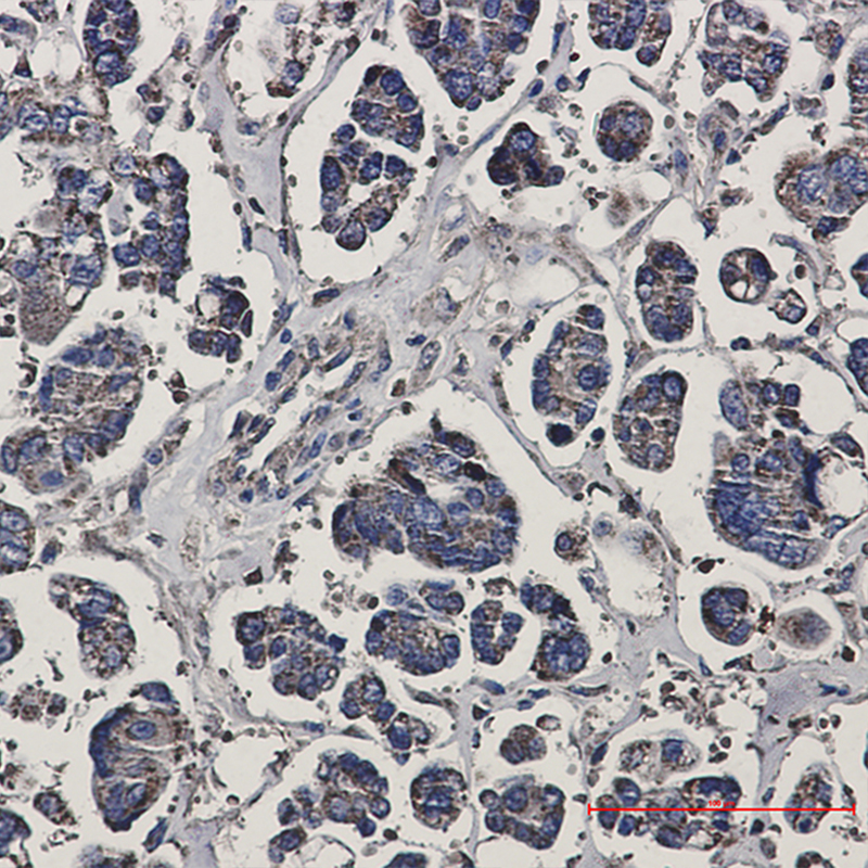 Immunohistochemistry of Prohibitin in paraffin-embedded Human Cholangiocarcinoma using Prohibitin Rabbit mAb at dilution 1:50