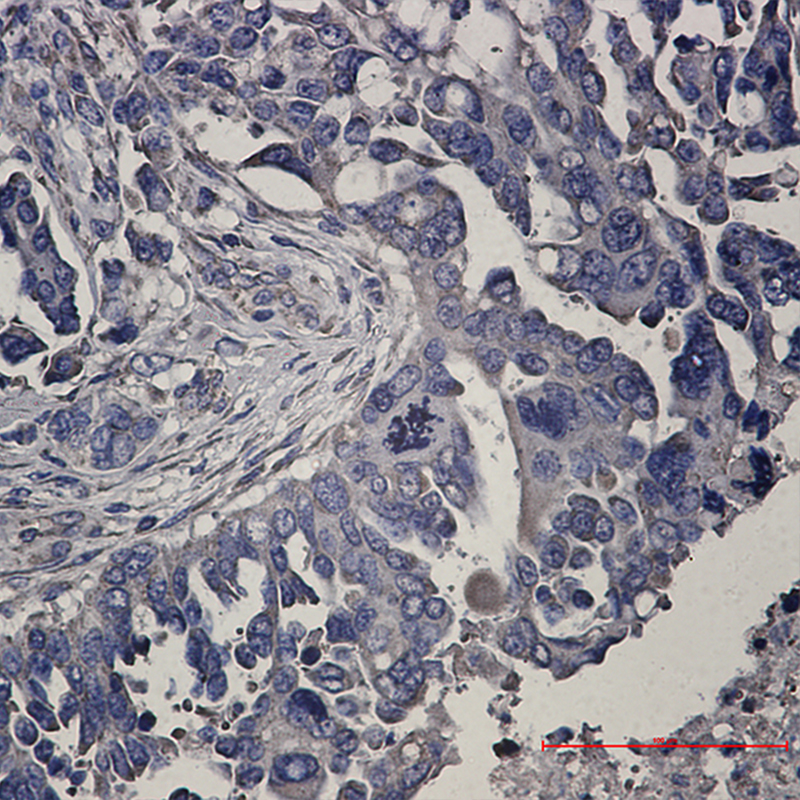 Immunohistochemistry of RENT1 in paraffin-embedded Human Cholangiocarcinoma using RENT1 Rabbit mAb at dilution 1:50