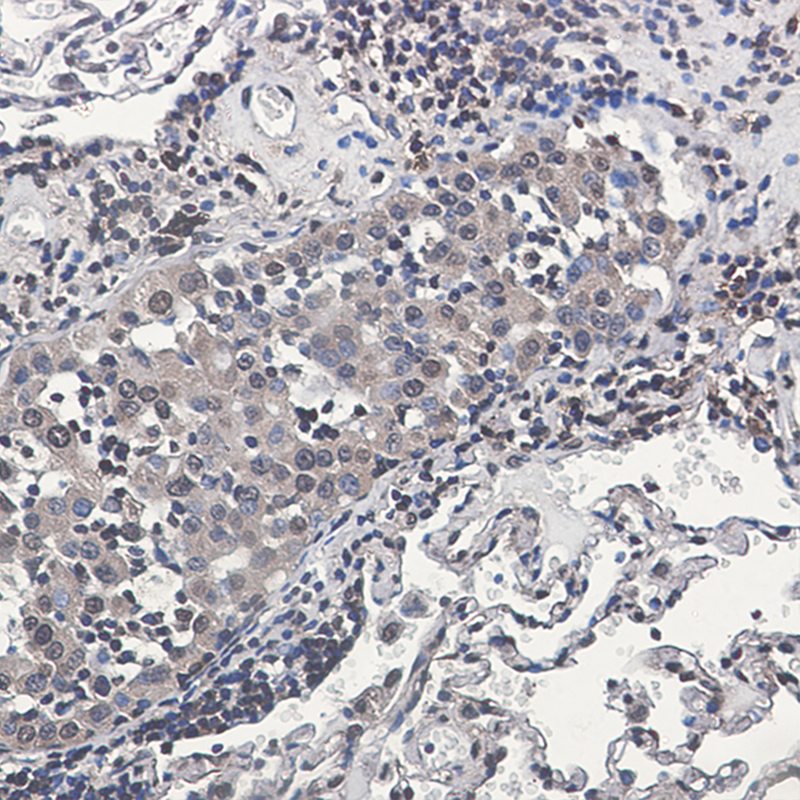 Immunohistochemistry of Rsk 2/MAPKAP Kinase 1b in paraffin-embedded Human lung cancer tissue using Rsk 2/MAPKAP Kinase 1b Rabbit mAb at dilution 1：50