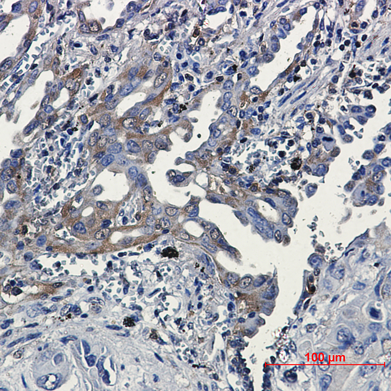 Immunohistochemical of RSK3 in Human lung cancer tissue using RSK3 antibody at dilution 1：20