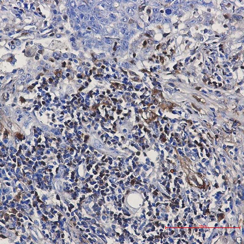 Immunohistochemistry of S100A4 in paraffin-embedded Human lung cancer tissue using S100A4 Rabbit mAb at dilution 1:50