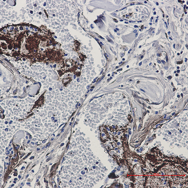 Immunohistochemistry of Thrombospondin 1 in paraffin-embedded Human Cholangiocarcinoma using Thrombospondin 1 Rabbit mAb at dilution 1:50