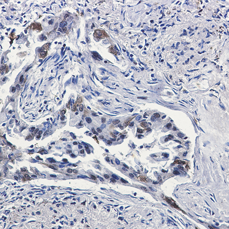 Immunohistochemistry of Tissue Factor in paraffin-embedded Human lung cancer tissue using Tissue Factor Rabbit mAb at dilution 1:50