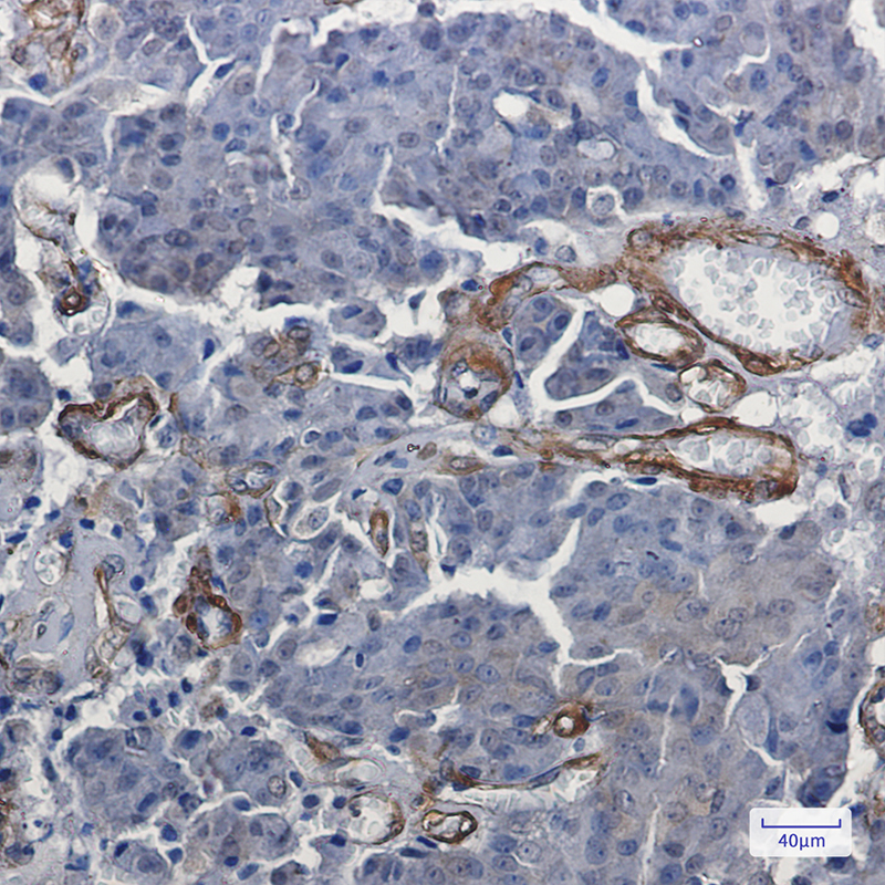 Immunohistochemistry of Vinculin in paraffin-embedded Human breast cancer tissue using Vinculin Rabbit mAb at dilution 1:50