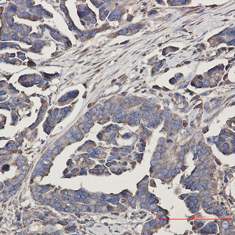 Immunohistochemistry of WDR1 in paraffin-embedded Human Cholangiocarcinoma using WDR1 Rabbit mAb at dilution 1:50