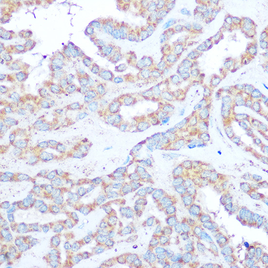 Immunohistochemistry of paraffin-embedded human thyroid cancer using TSC2 Polyclonal Antibody at dilution of 1:100 (40x lens).Perform microwave antigen retrieval with 10 mM Tris/EDTA buffer pH 9.0 before commencing with IHC staining protocol.