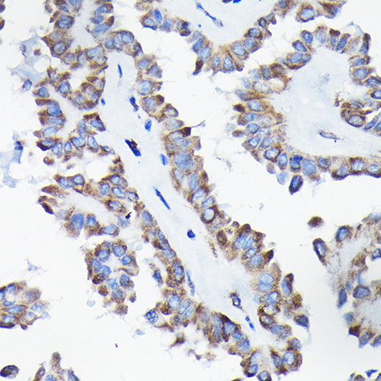 Immunohistochemistry of paraffin-embedded human thyroid cancer using [KO Validated] AIF Polyclonal Antibody at dilution of 1:50 (40x lens).Perform high pressure antigen retrieval with 10 mM citrate buffer pH 6.0 before commencing with IHC staining protocol.