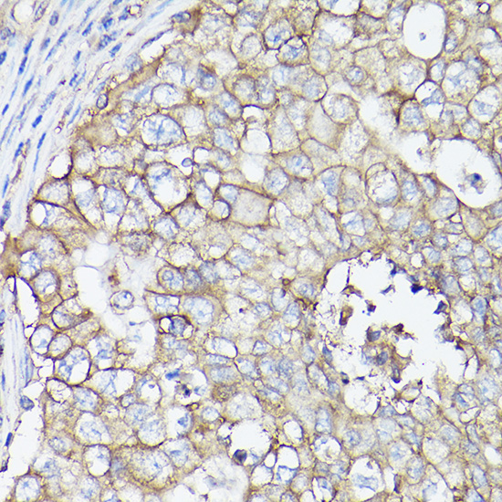 Immunohistochemistry of paraffin-embedded human breast cancer using MCT4/SLC16A3 Polyclonal Antibody at dilution of 1:100 (40x lens).Perform high pressure antigen retrieval with 10 mM citrate buffer pH 6.0 before commencing with IHC staining protocol.