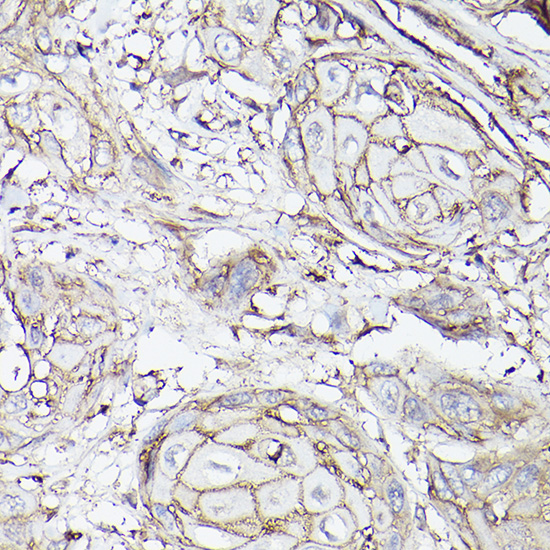 Immunohistochemistry of paraffin-embedded human esophageal cancer using MCT4/SLC16A3 Polyclonal Antibody at dilution of 1:100 (40x lens).Perform high pressure antigen retrieval with 10 mM citrate buffer pH 6.0 before commencing with IHC staining protocol.